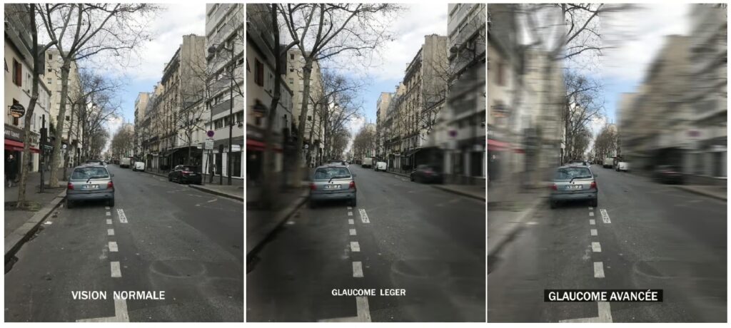 Image à gauche montrant une vision normale, image au milieu montrant un glaucome léger, image à droite montrant un glaucome avancée.
