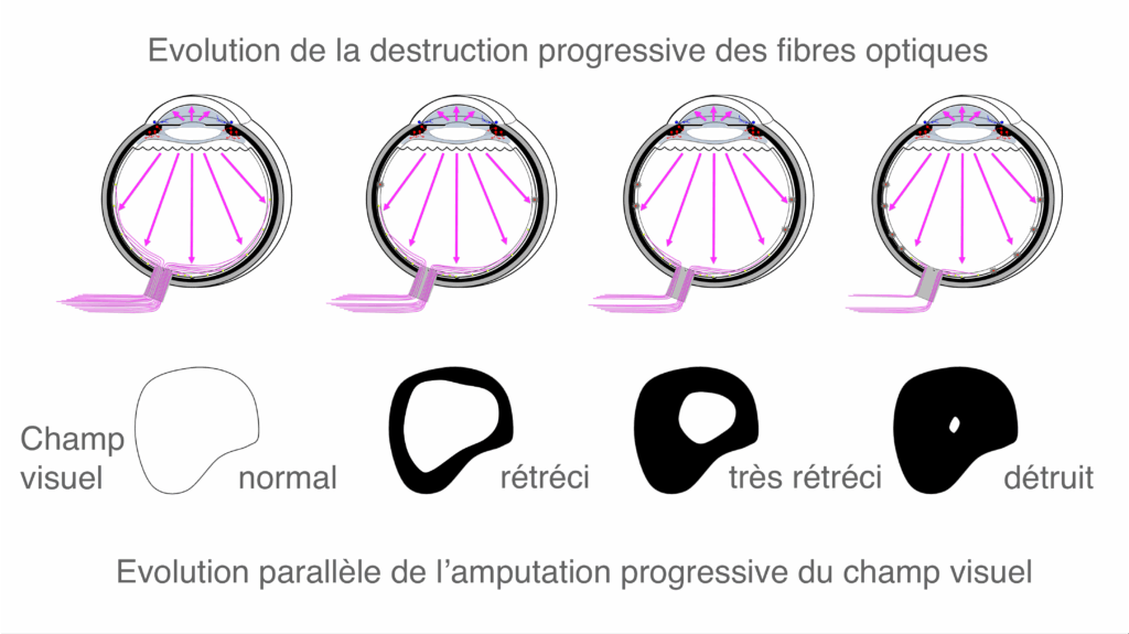 Image montrant l'évolution de la maladie avec un rétrécissement de la vision